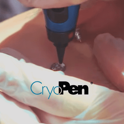 CryoPen Device