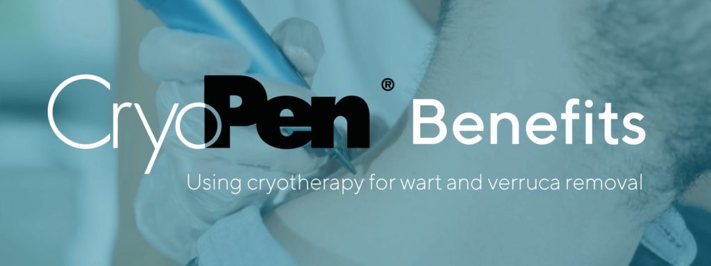CryoPen benefits: Using Cryotherapy for Wart and Verruca removal
