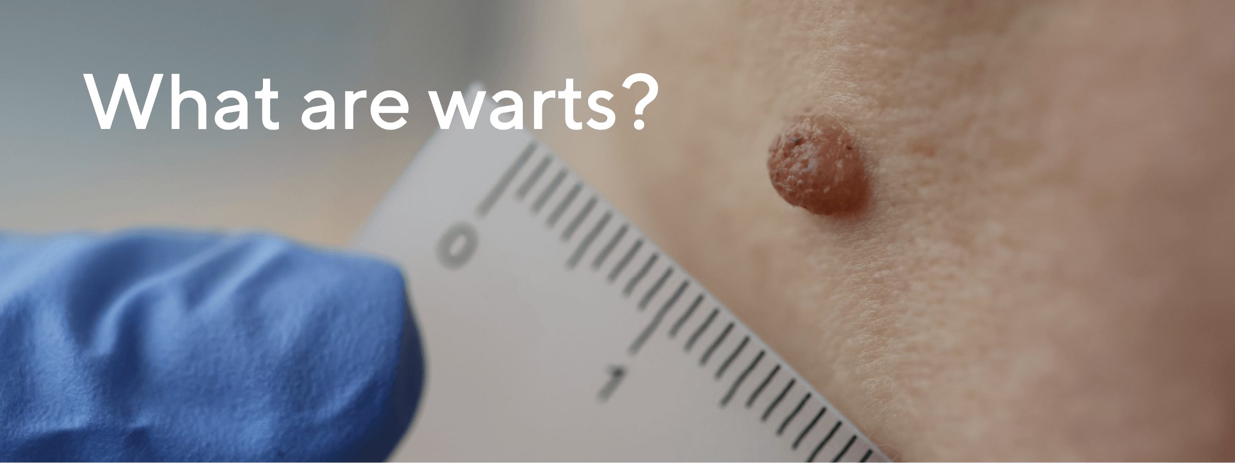 What are warts?
