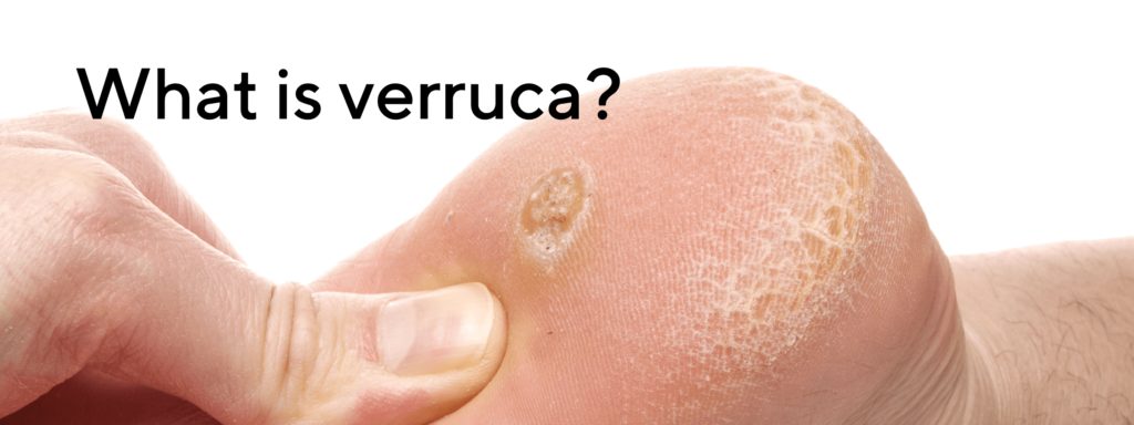 What is verruca?
