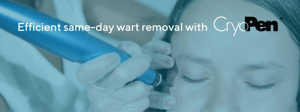 Efficient same day wart removal with cryopen