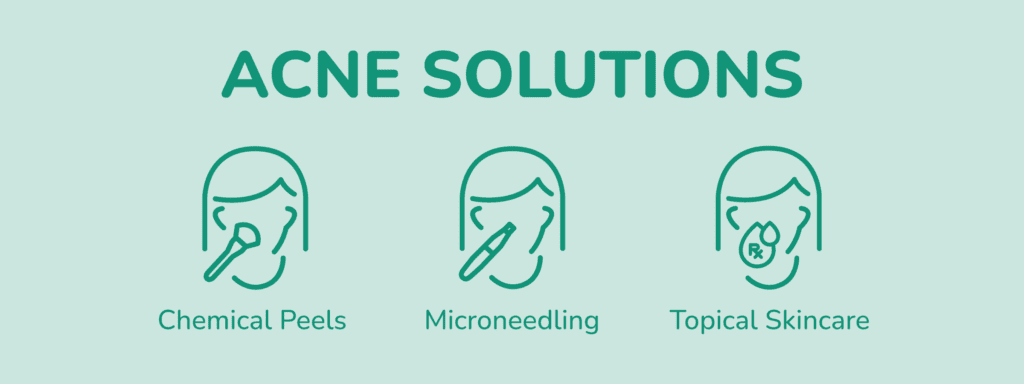 Solutions For Acne