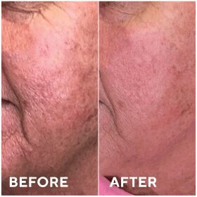 Microneedling before and after