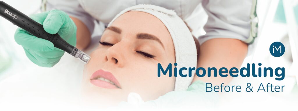 Microneedling Before and After Header