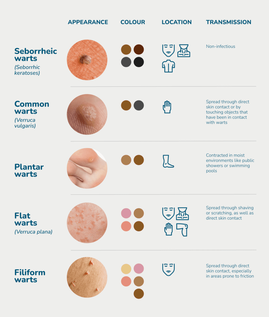 Seborrheic Warts Chart